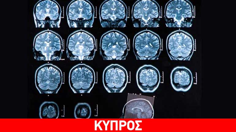 Περίπου 1.300 άνθρωποι στην Κύπρο υποφέρουν από σκλήρυνση κατά πλάκας
